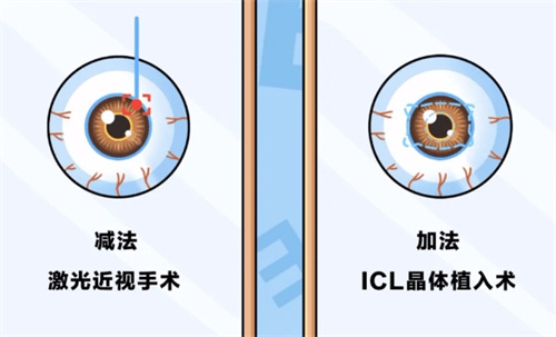 近视手术的分类