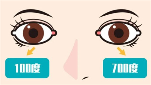 近视双眼度数相差大