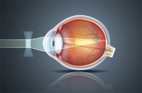 近视眼视光图